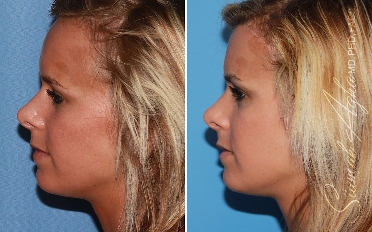 Forehead Reduction Before & After