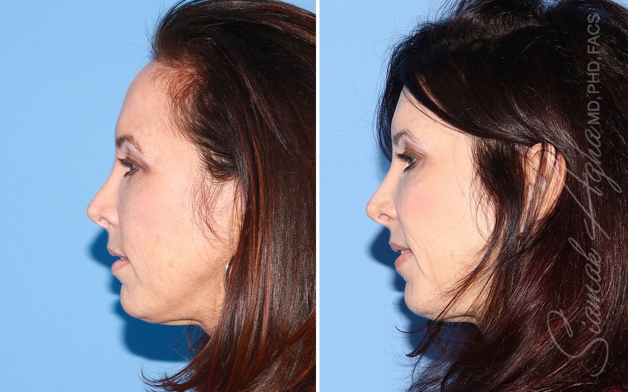 Forehead Reduction Before & After