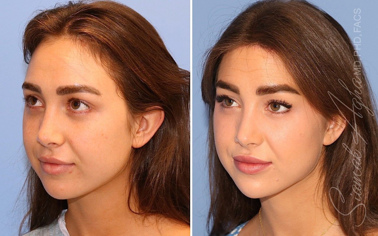 Forehead Reduction Before & After