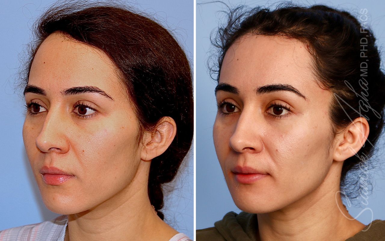 Forehead Reduction Before & After