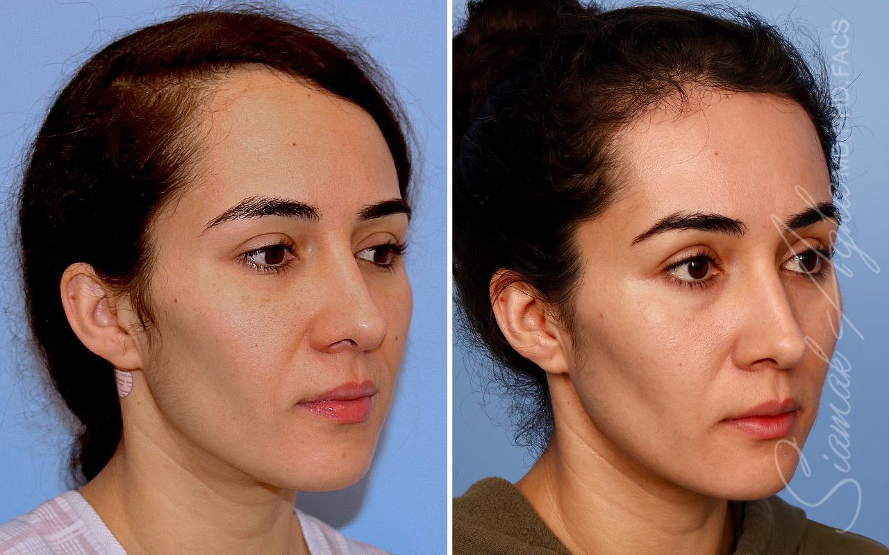 Forehead Reduction Before & After