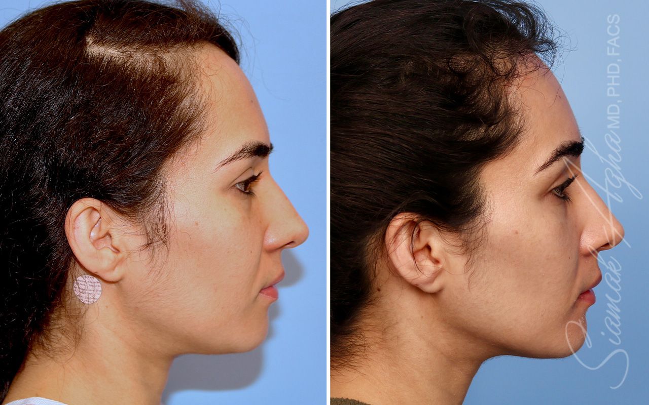 Forehead Reduction Before & After