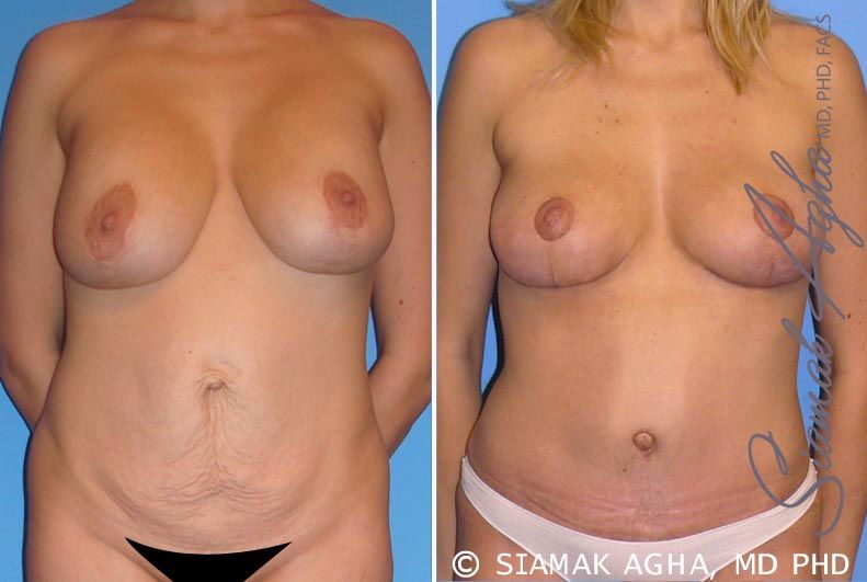 Breast Lift Before & After