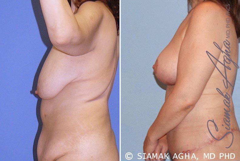 Breast Lift Before & After