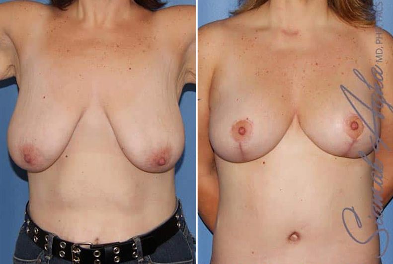 Breast Lift Before & After