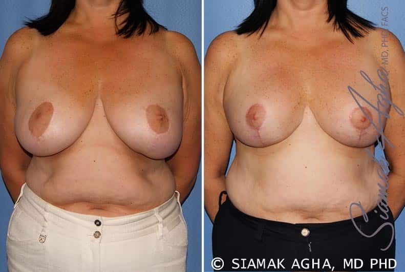 Breast Lift Before & After
