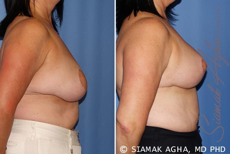 Breast Lift Before & After