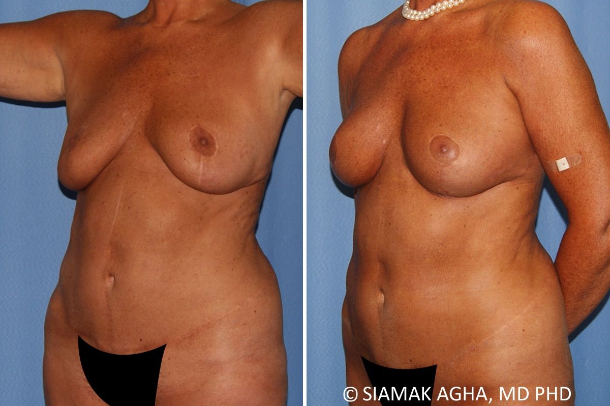 Breast Lift Before & After