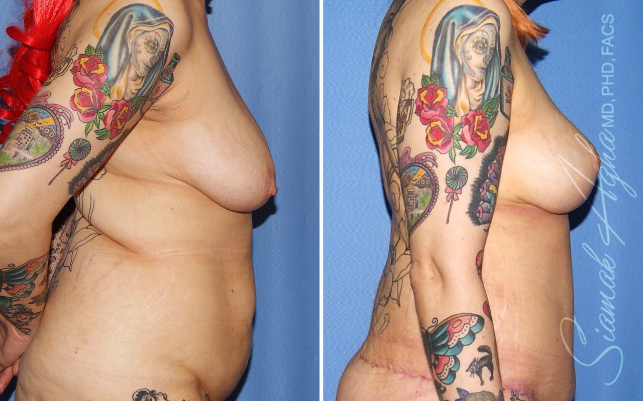 Breast Lift Before & After