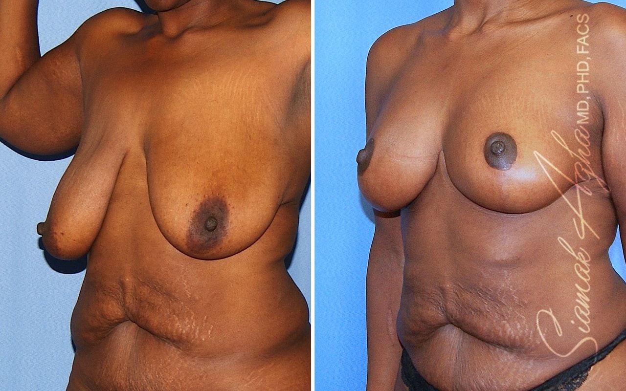 Breast Lift Before & After