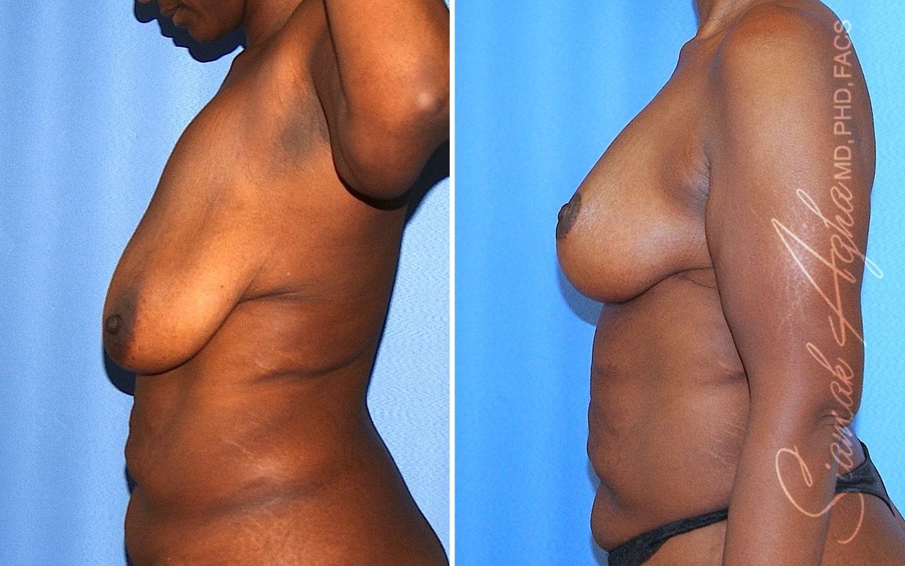 Breast Lift Before & After