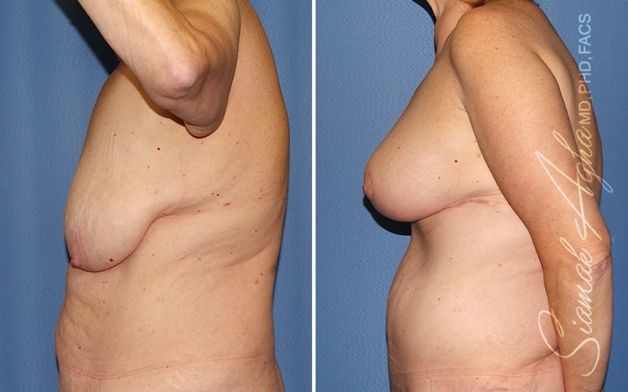 Breast Lift Before & After