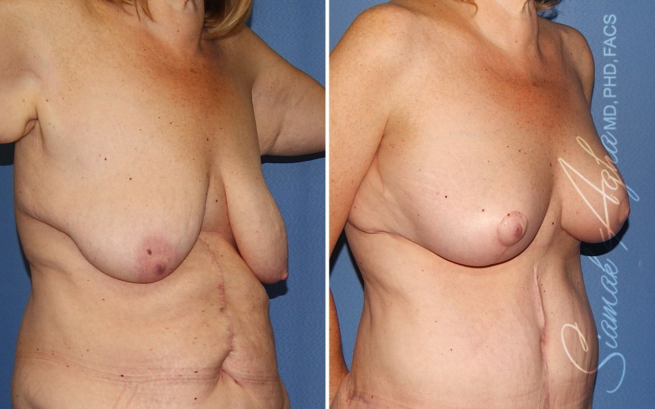 Breast Lift Before & After