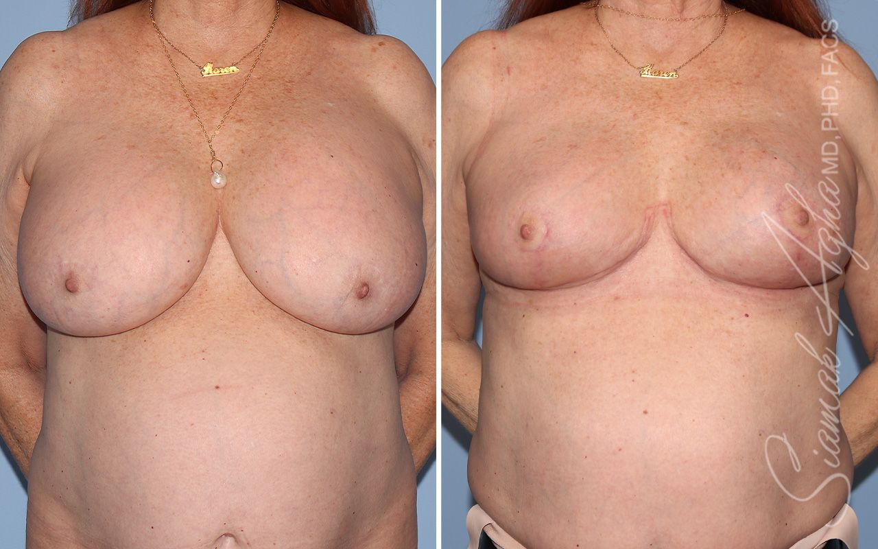 Breast Lift Before & After