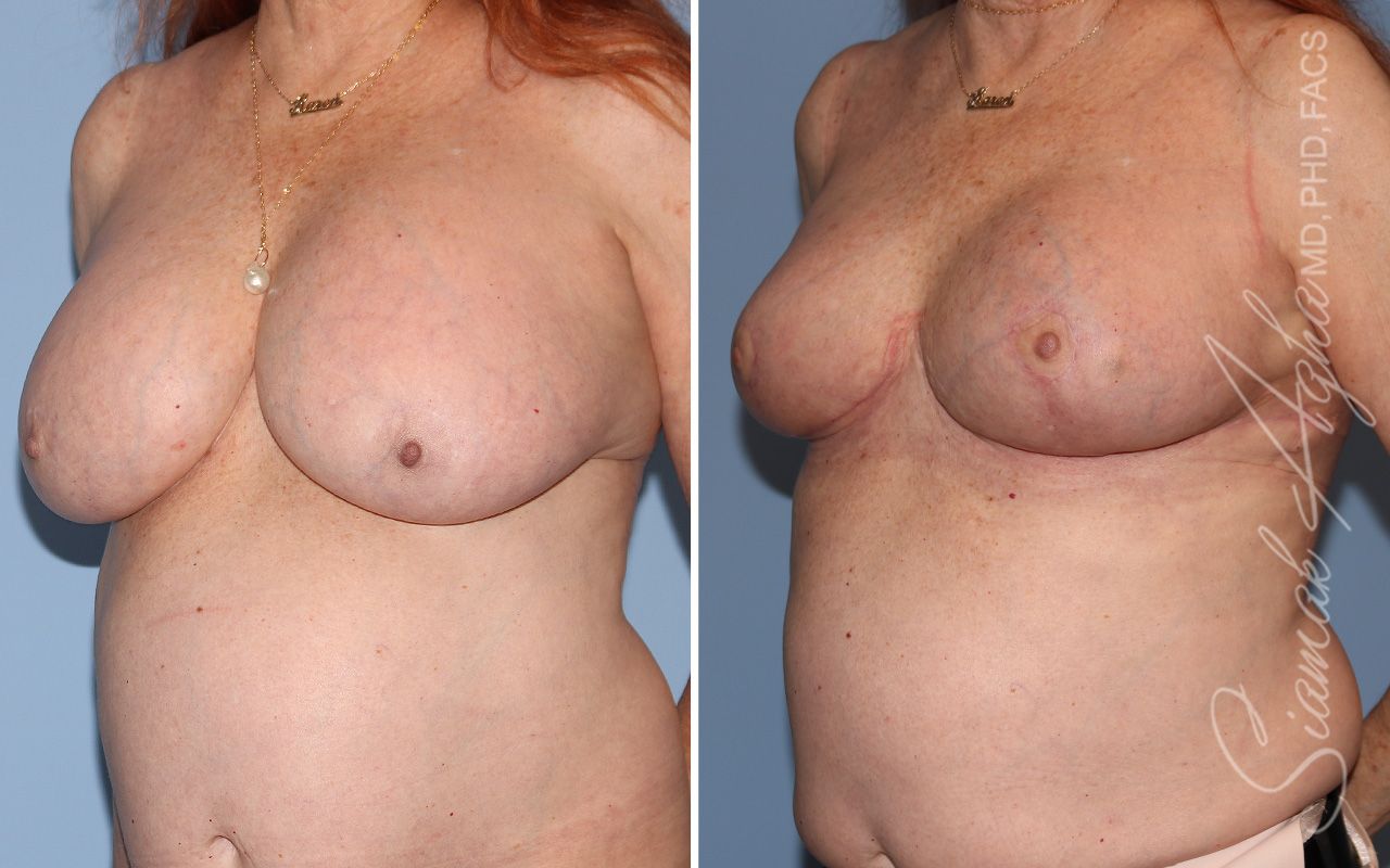 Breast Lift Before & After