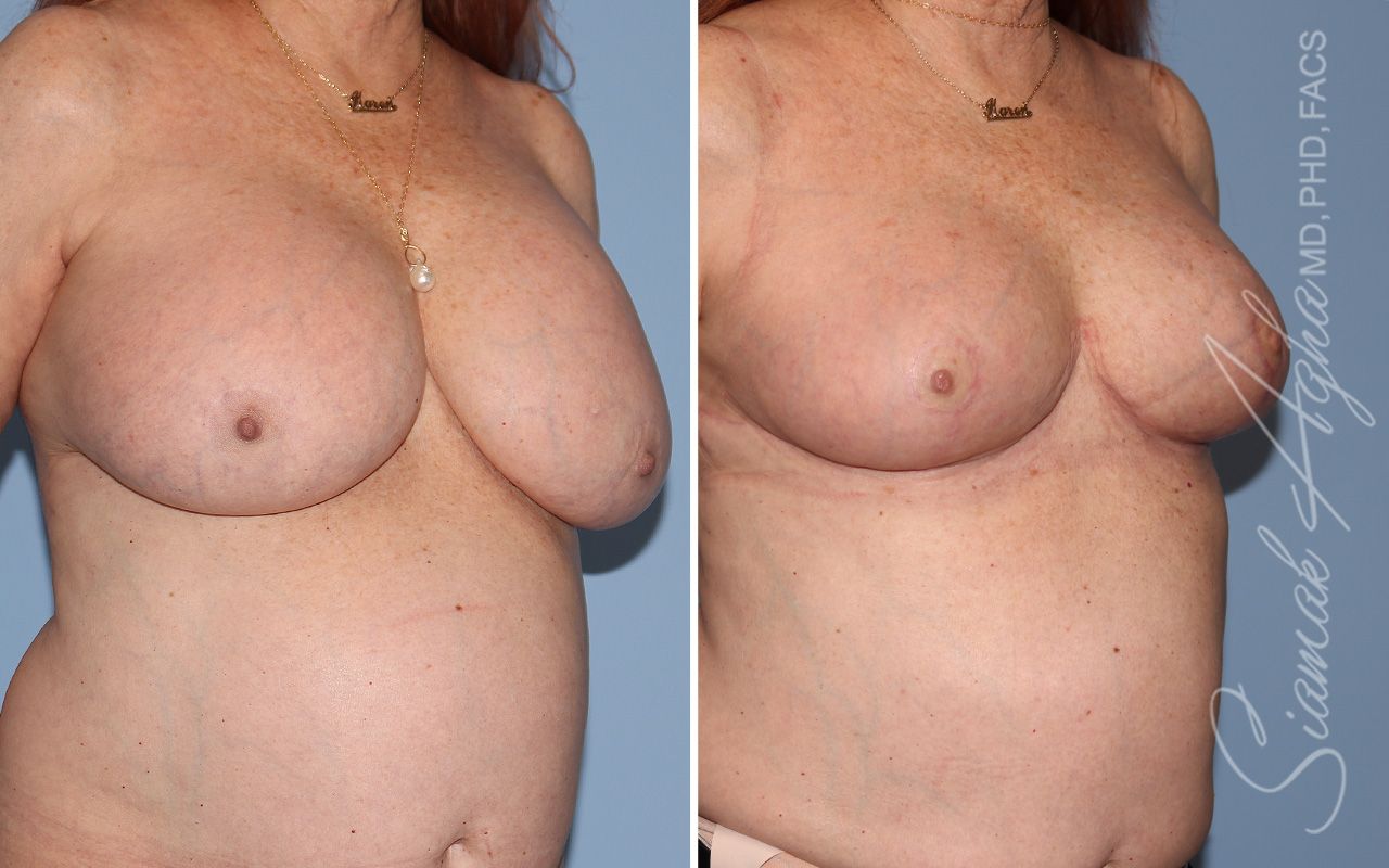 Breast Lift Before & After