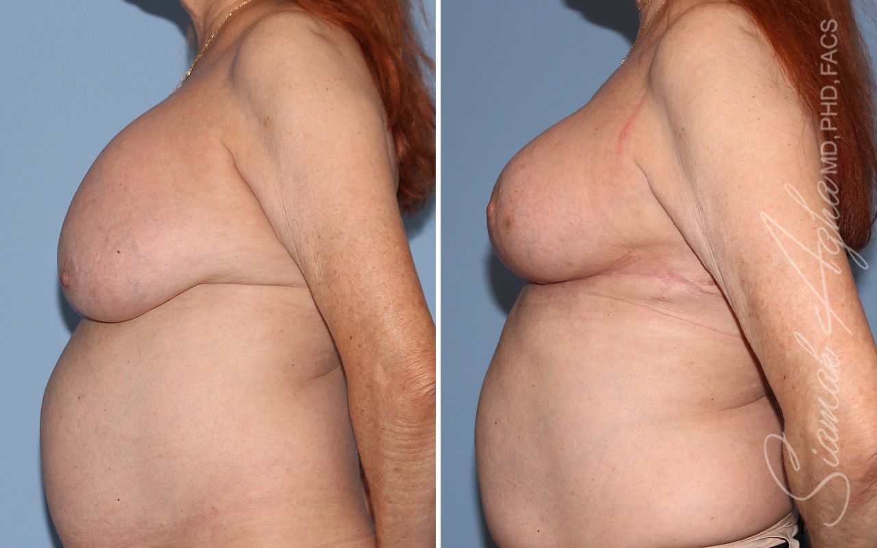 Breast Lift Before & After
