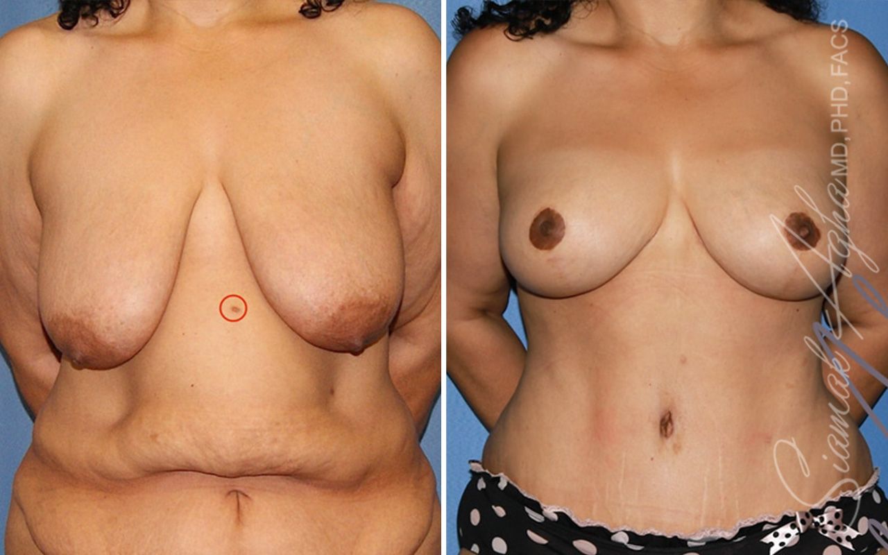 Breast Lift Before & After