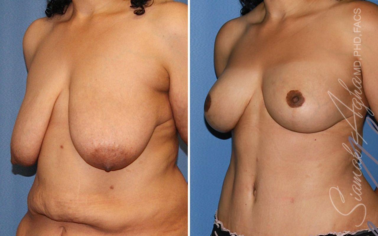 Breast Lift Before & After