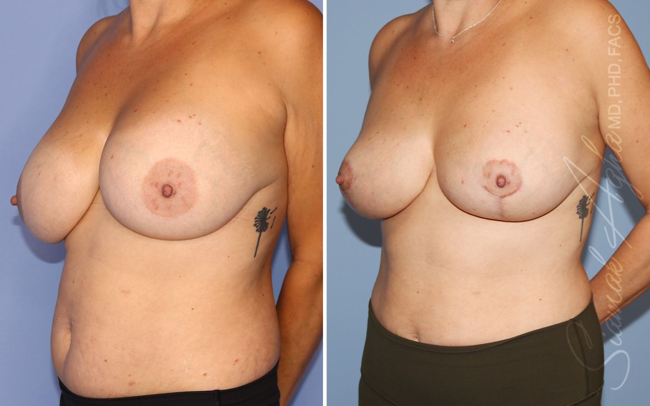 Breast Lift Before & After
