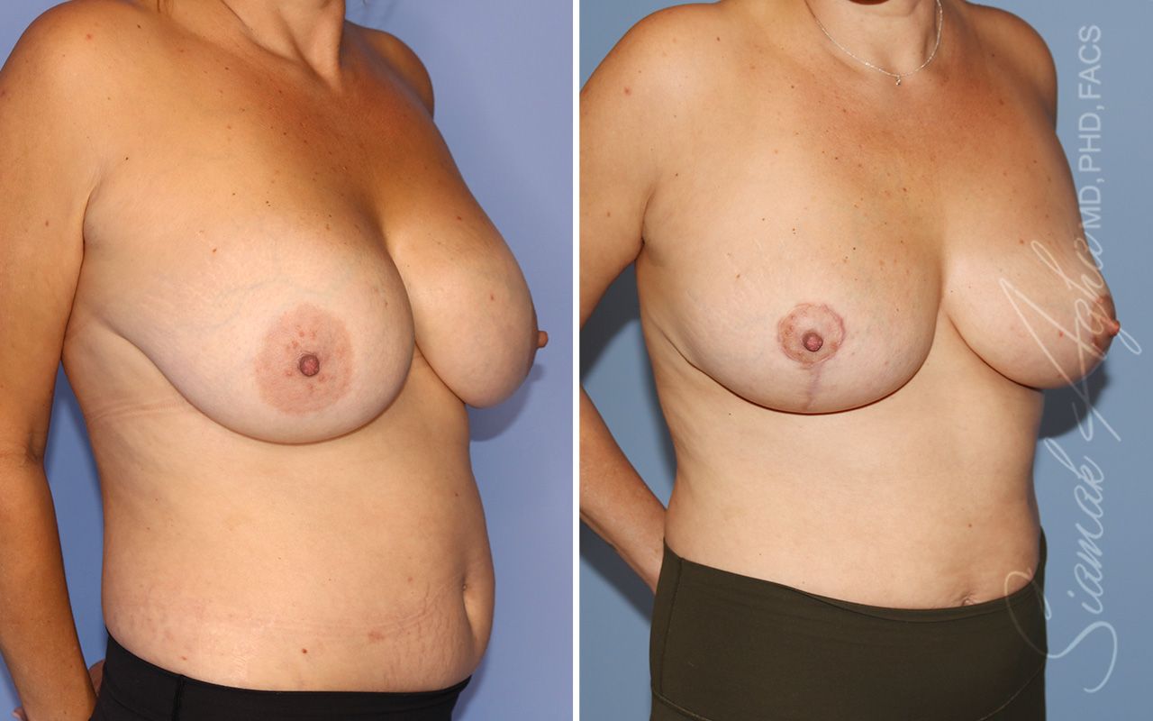 Breast Lift Before & After