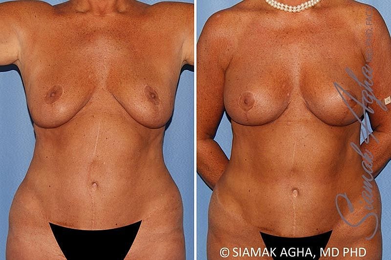 Breast Lift Before & After