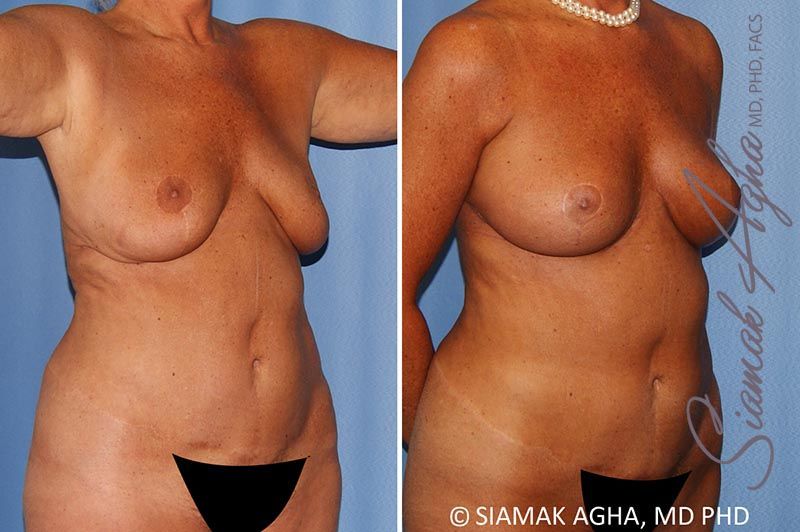 Breast Lift Before & After