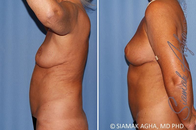 Breast Lift Before & After