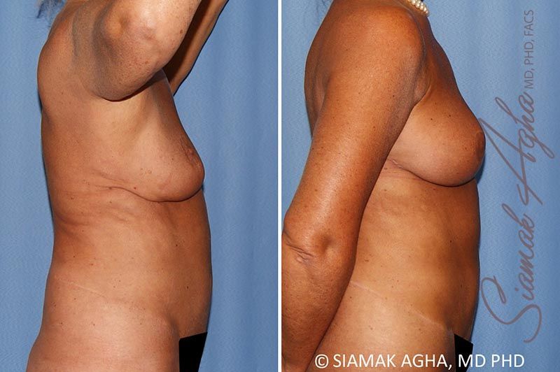 Breast Lift Before & After