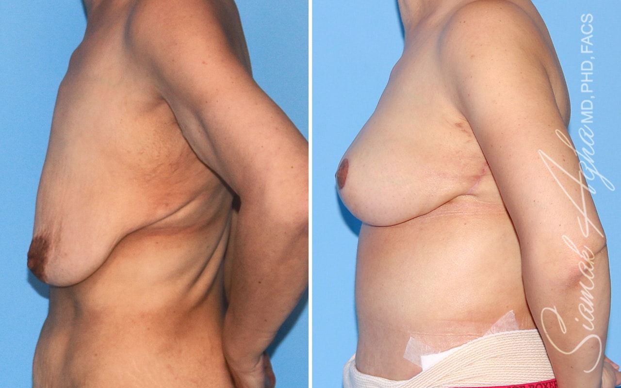 Breast Lift Before & After