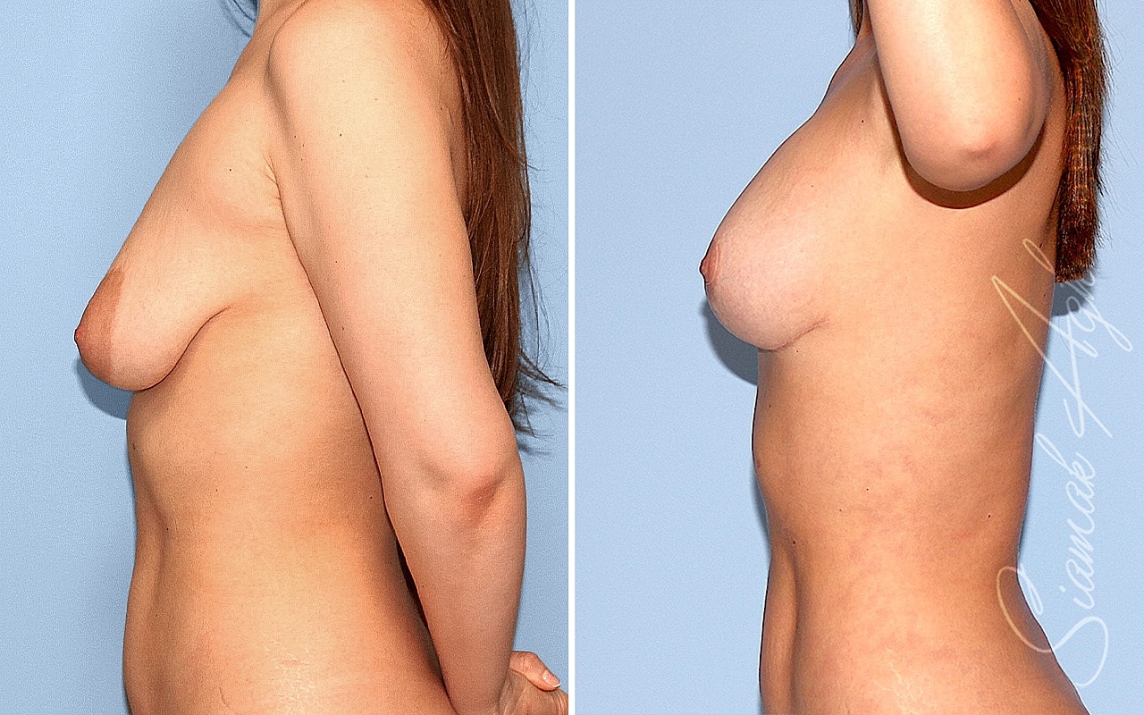 Breast Lift Before & After
