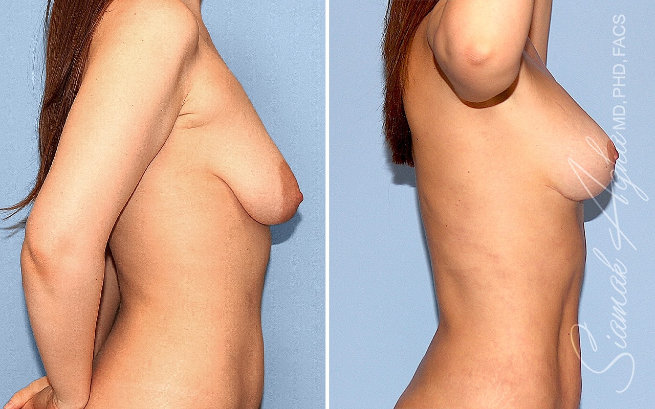 Breast Lift Before & After