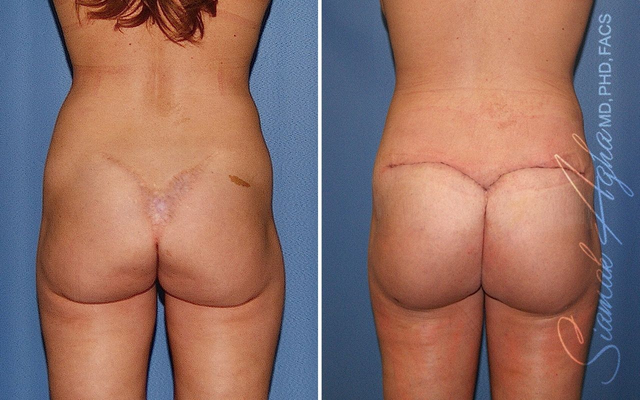 Buttock Correction Before & After