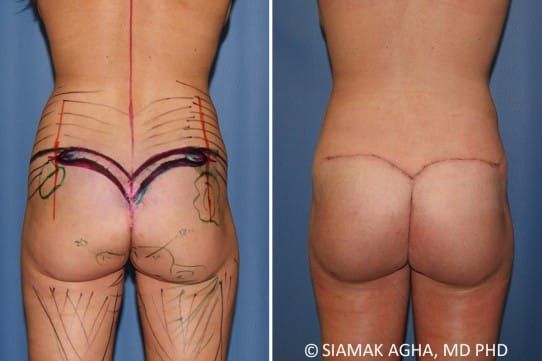 Buttock Correction Before & After