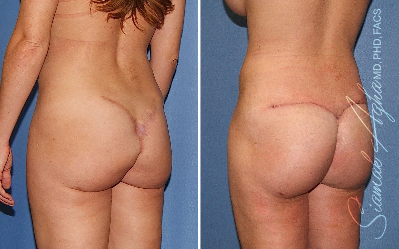 Buttock Correction Before & After