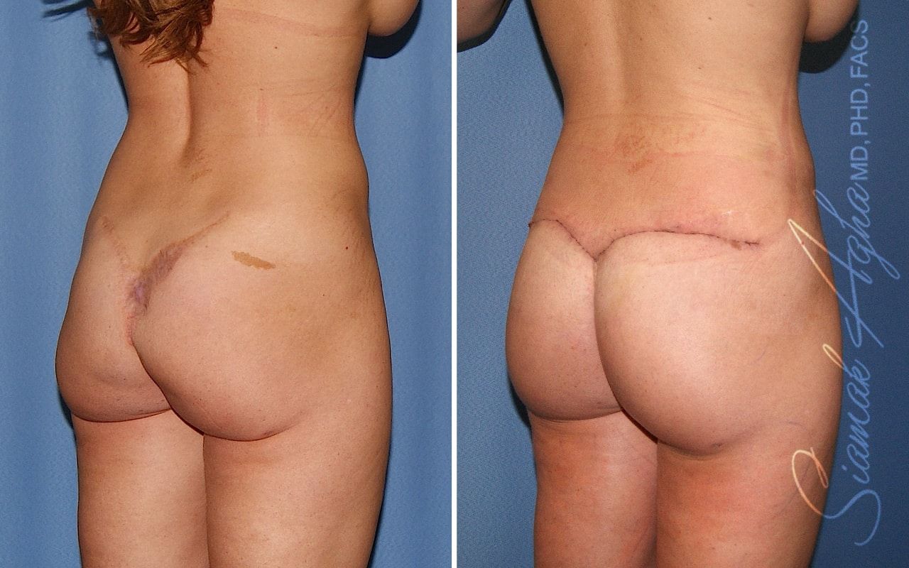 Buttock Correction Before & After