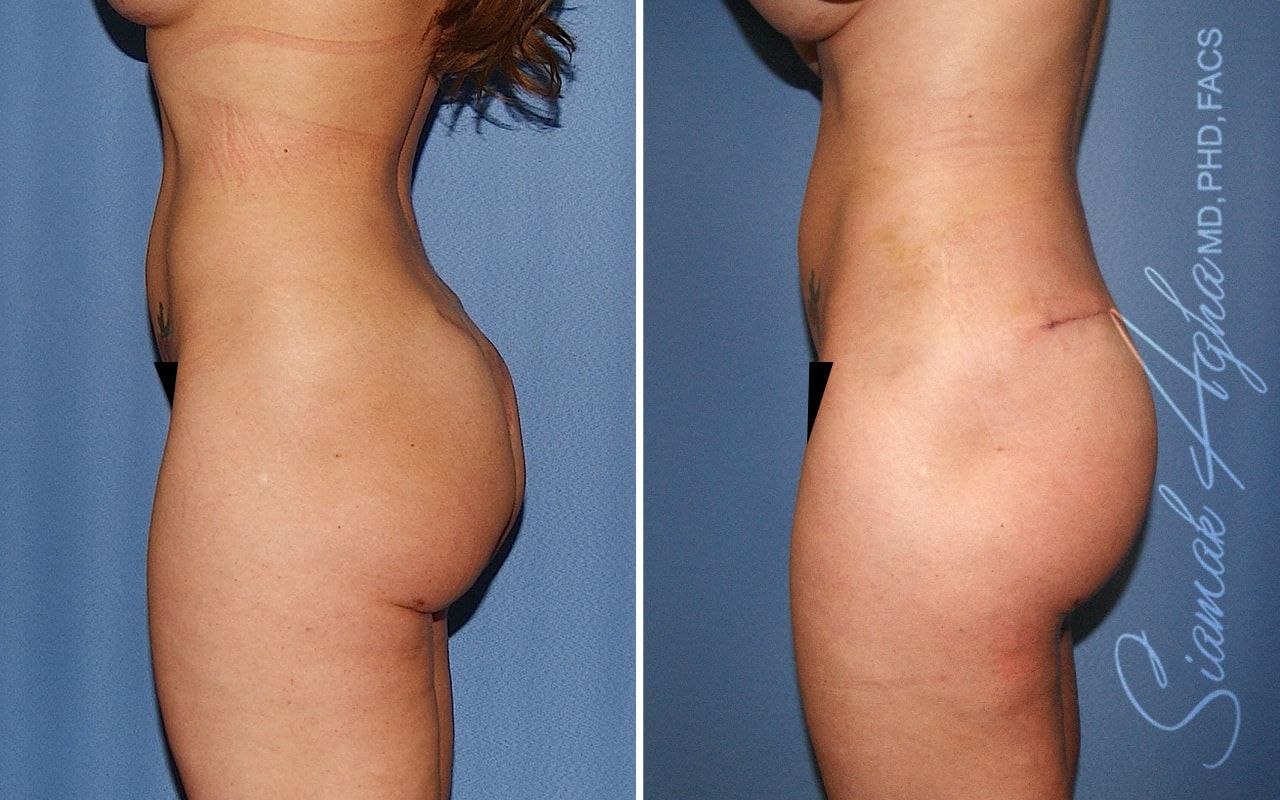 Buttock Correction Before & After