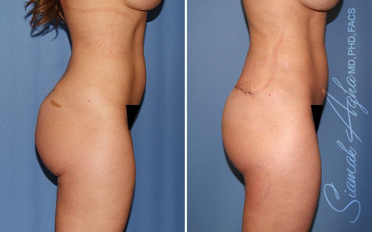 Buttock Correction Before & After