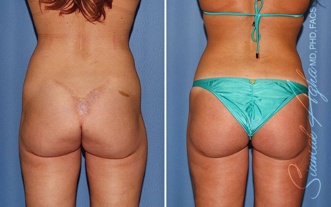 Buttock Correction Before & After