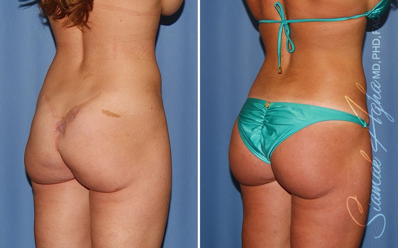 Buttock Correction Before & After