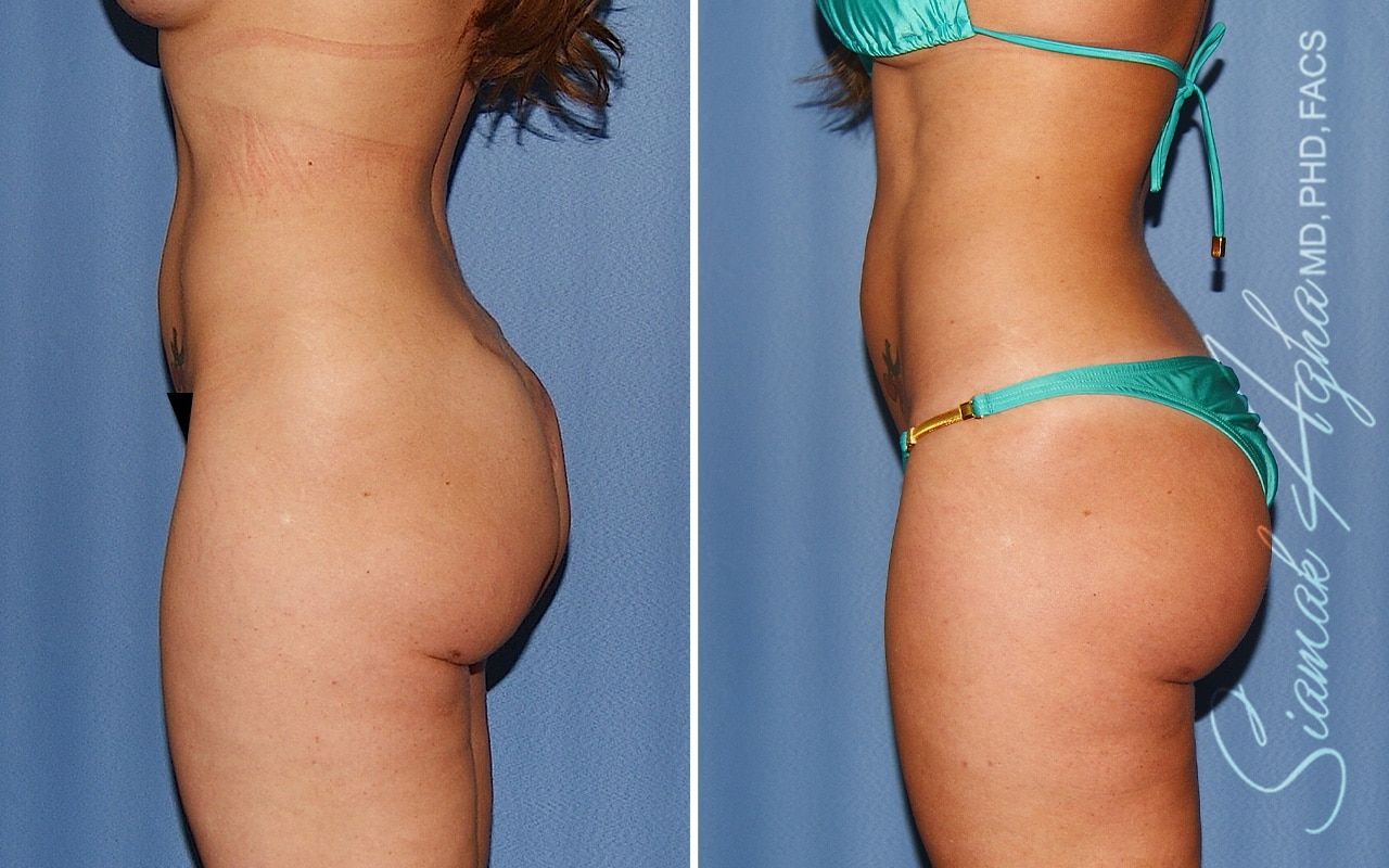 Buttock Correction Before & After