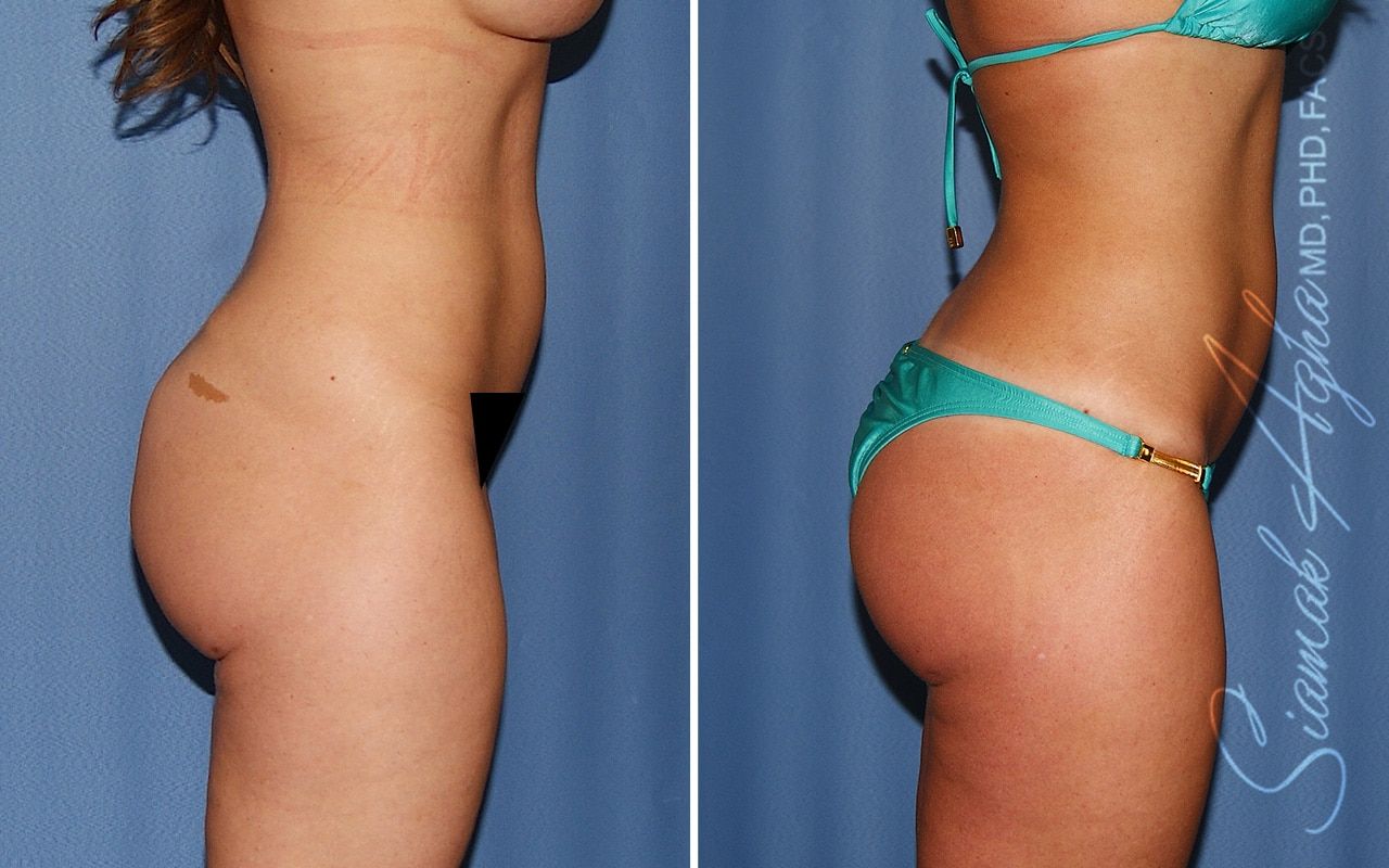 Buttock Correction Before & After