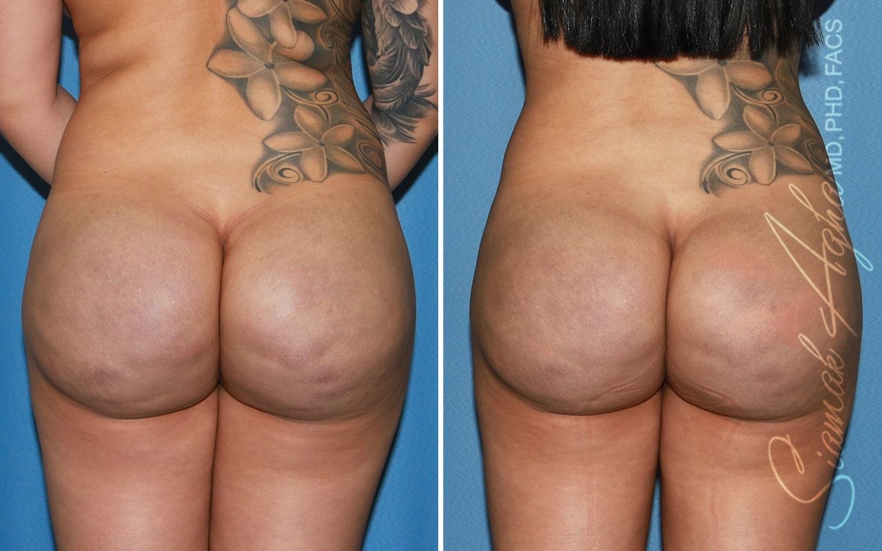 Buttock Correction Before & After