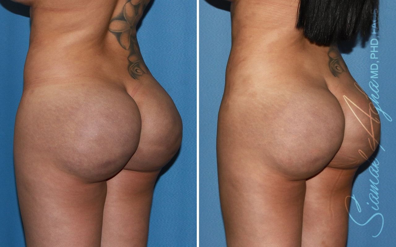 Buttock Correction Before & After