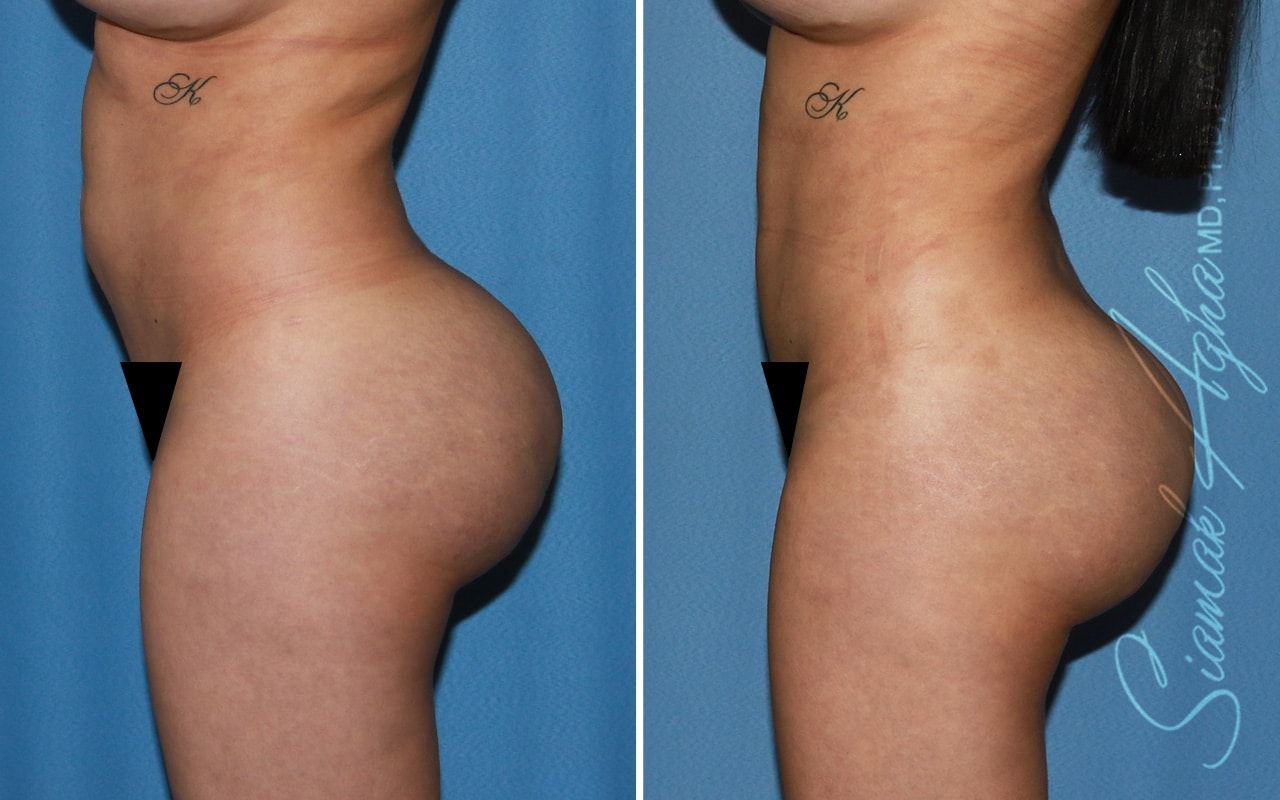 Buttock Correction Before & After