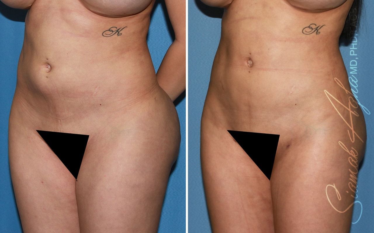 Buttock Correction Before & After