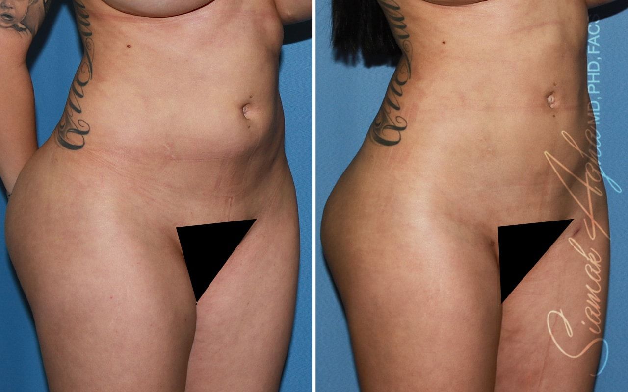 Buttock Correction Before & After