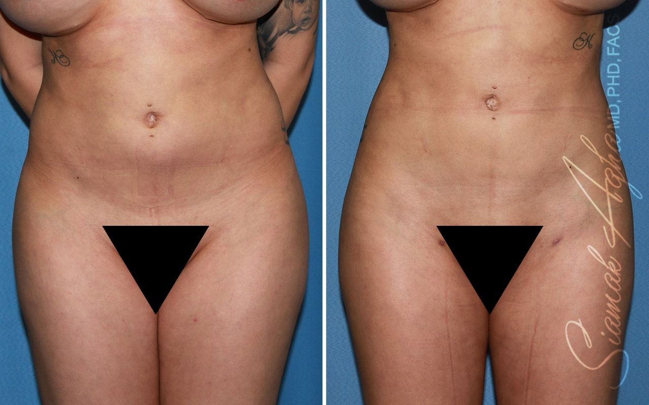 Buttock Correction Before & After
