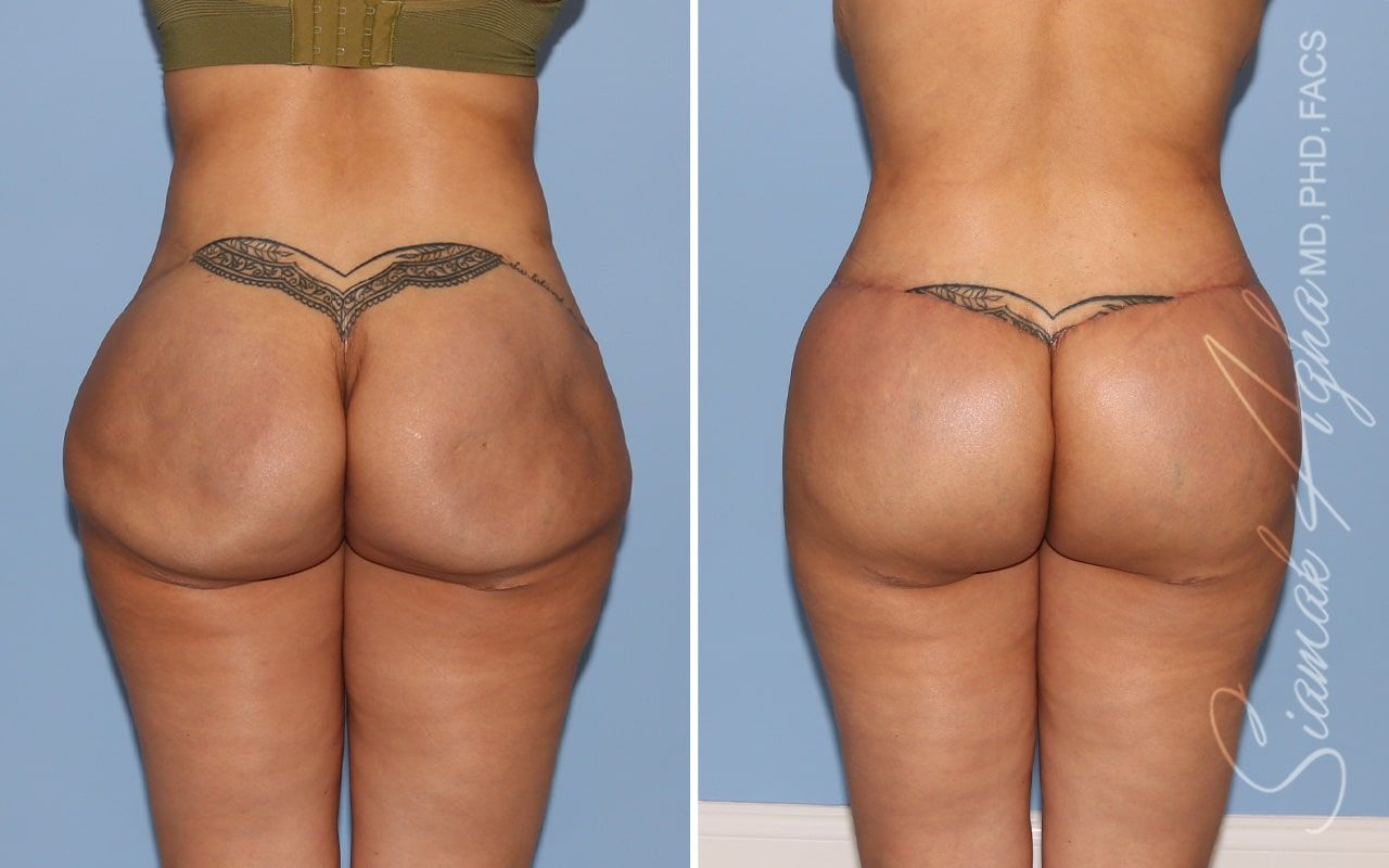 Buttock Correction Before & After