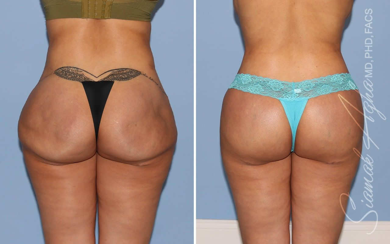 Buttock Correction Before & After